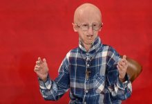 Survivor of rare rapid-ageing disease progeria dies at 28